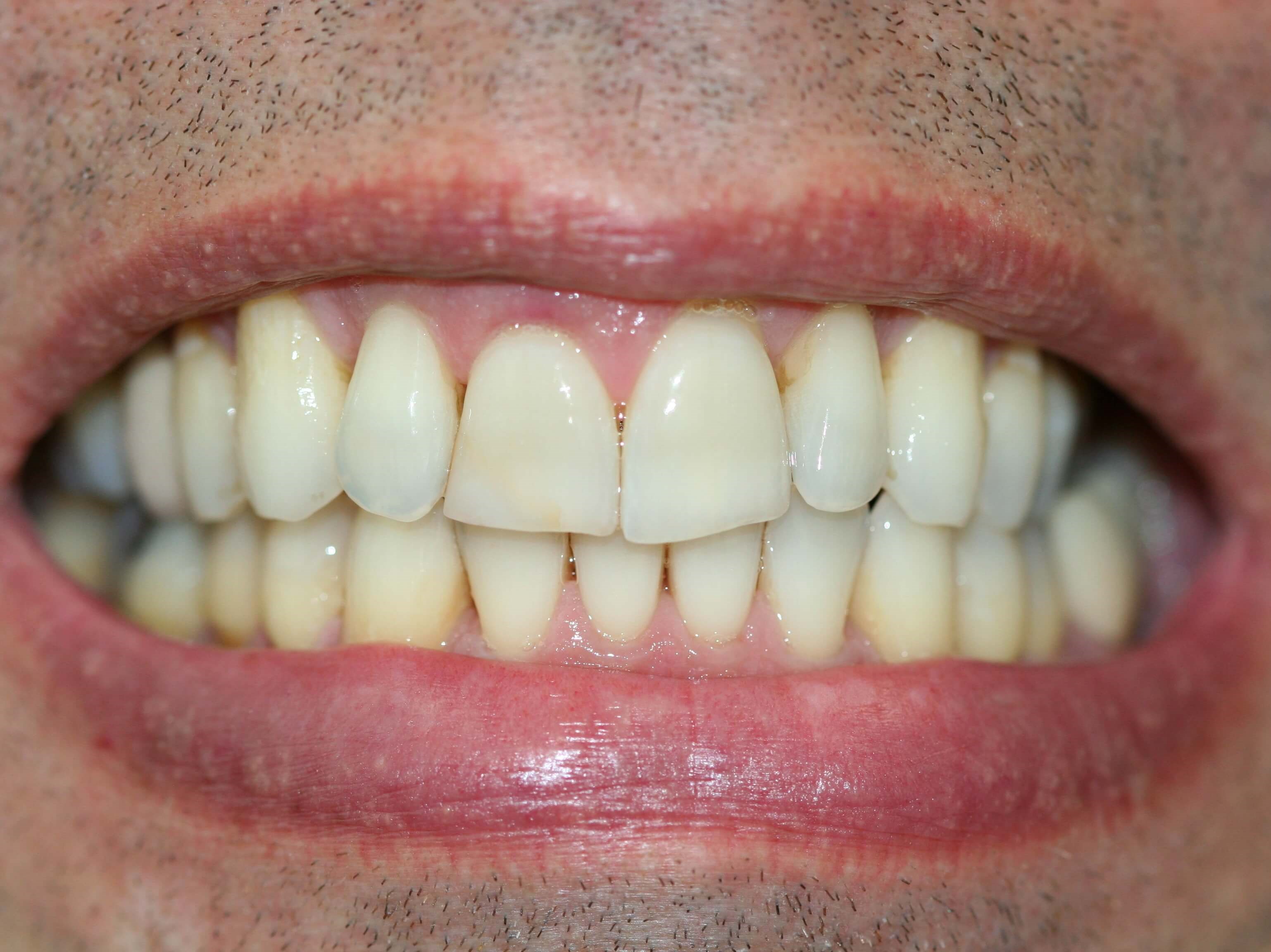 Teeth whitening trays gums white