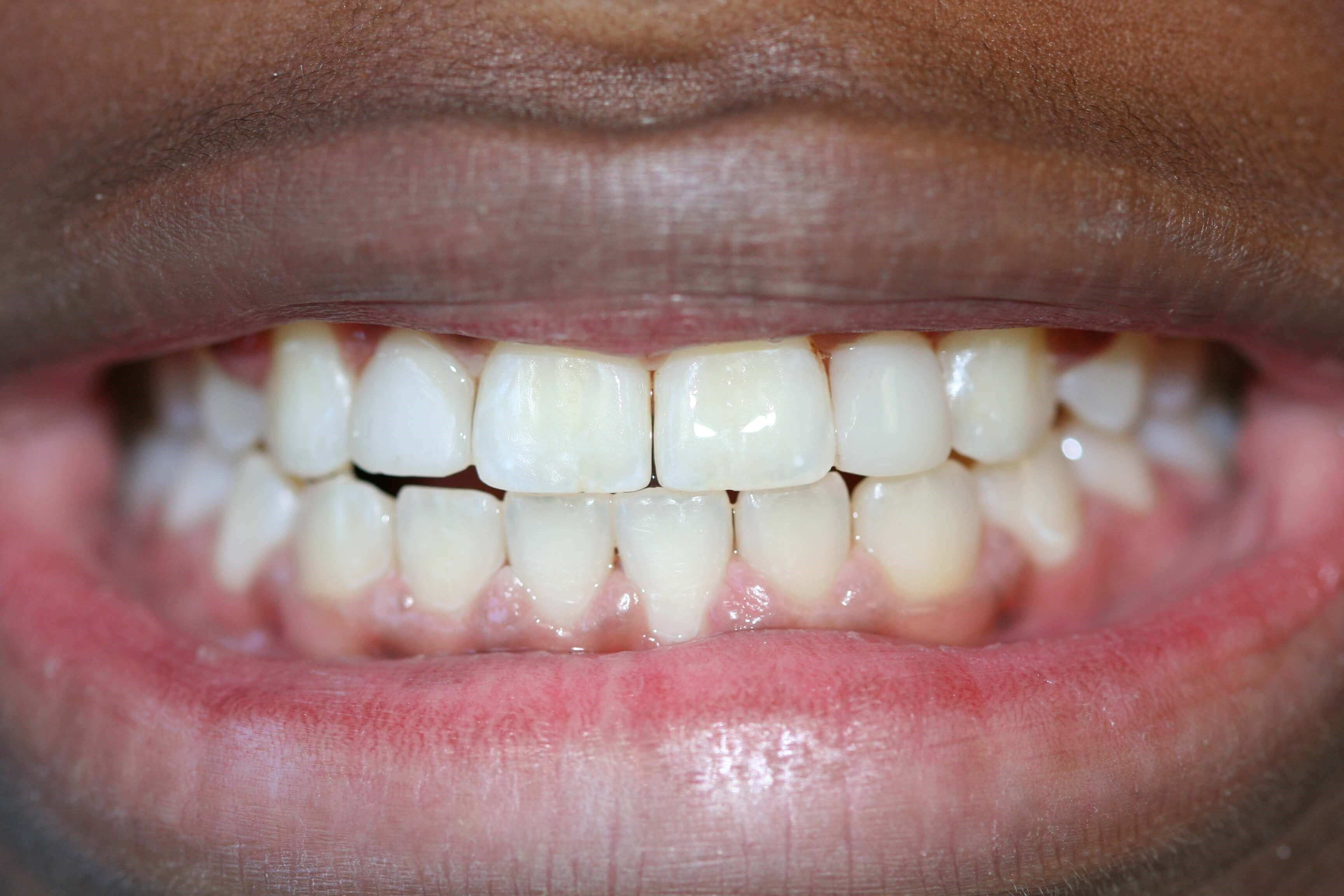 Veneers to correct underdeveloped teeth
