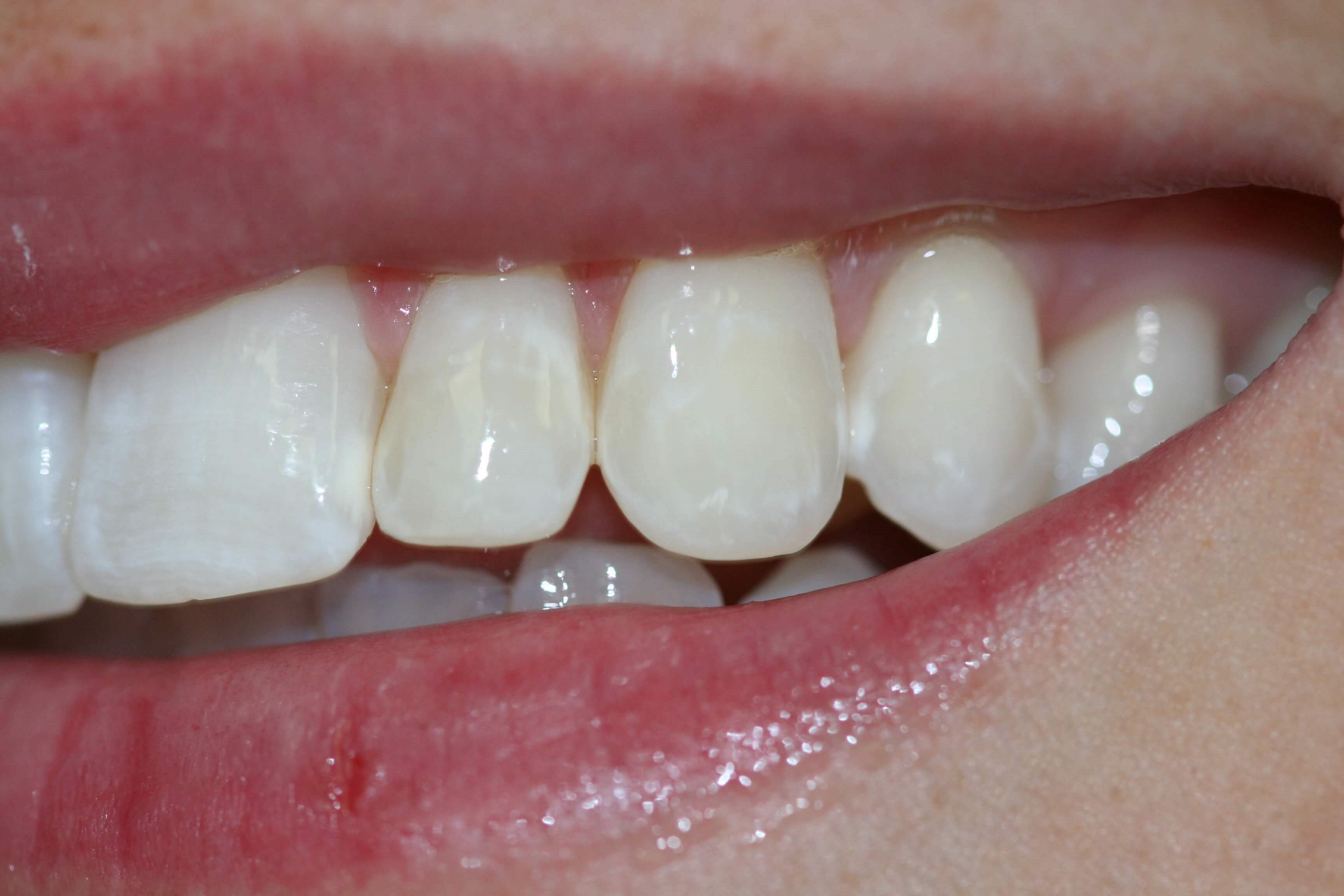 Damaged Enamel Repaired With Resin Bonding